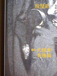MRI大腿骨.JPG